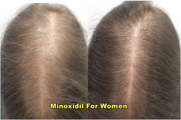 Minoxidil For Women